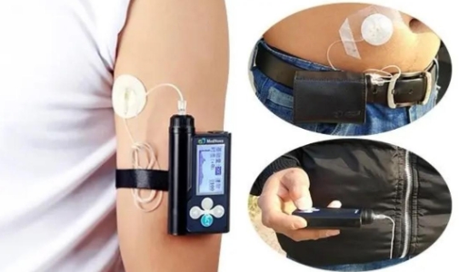 植入式胰島素 植入式胰島素